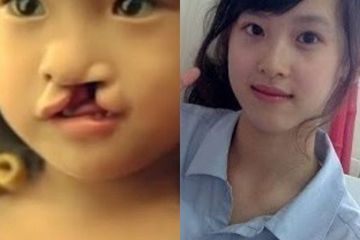 Operasi-Gratis-Celah-Bibir-dan-Langit-langit-di-RS-Bhakti-Husada-Krikilan-Banyuwangi