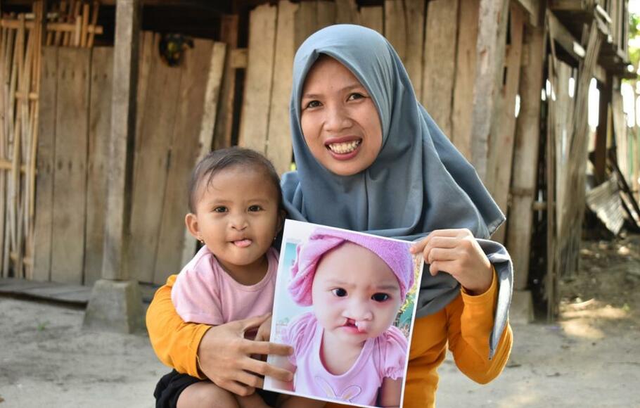 Gratis ! Operasi Bibir Sumbing Ini Syarat Dan Jadwalnya